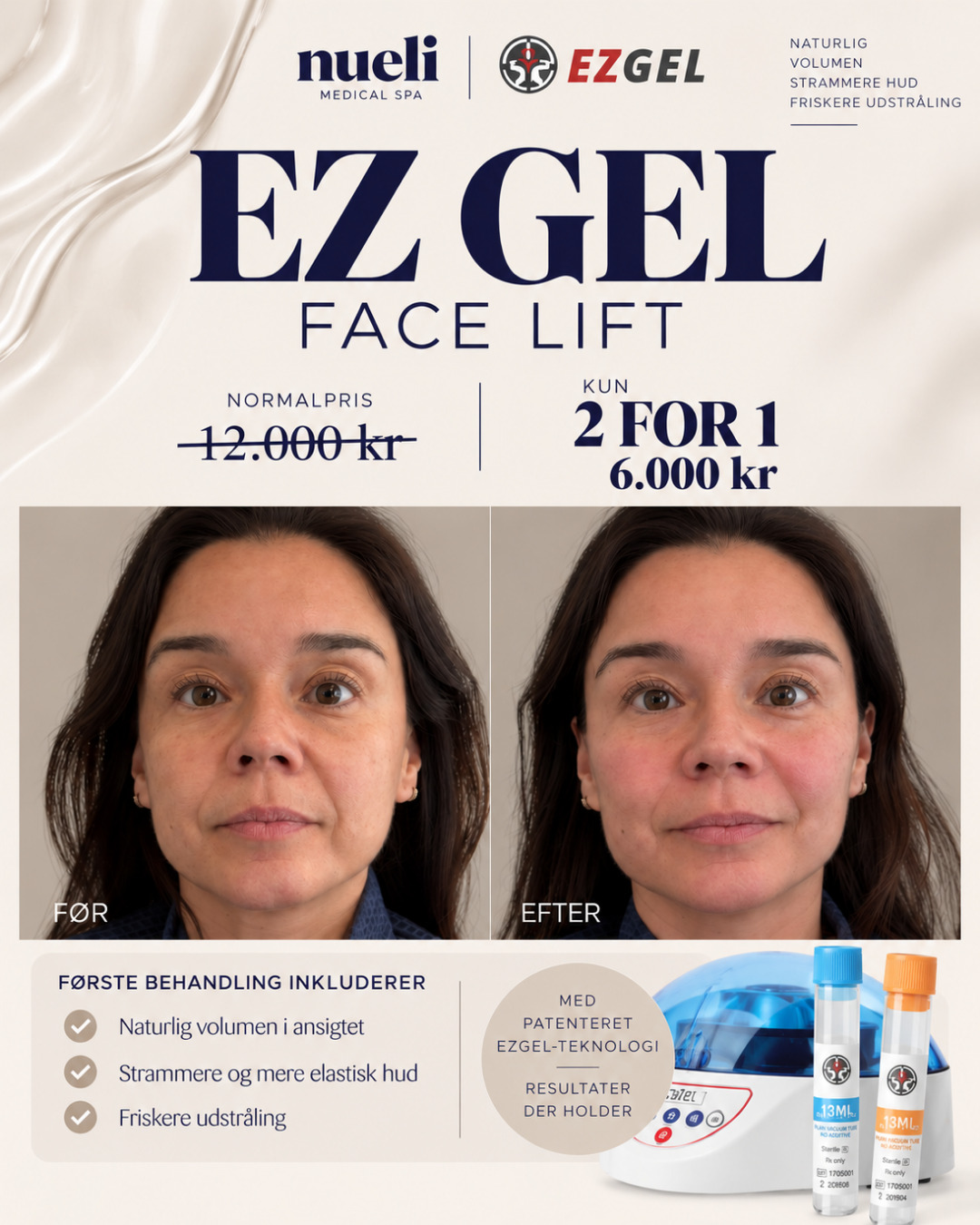 EZ Gel Face Lift 2 for 1. Spar 50&nbsp;%. Kun 6.000&nbsp;kr for 2&nbsp;behandlinger. Før og efter.